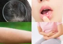 Korpásodás, szájsebesedés, lúdbőr, székrekedés? Ez a vitamin hiányzik a szervezetedből!