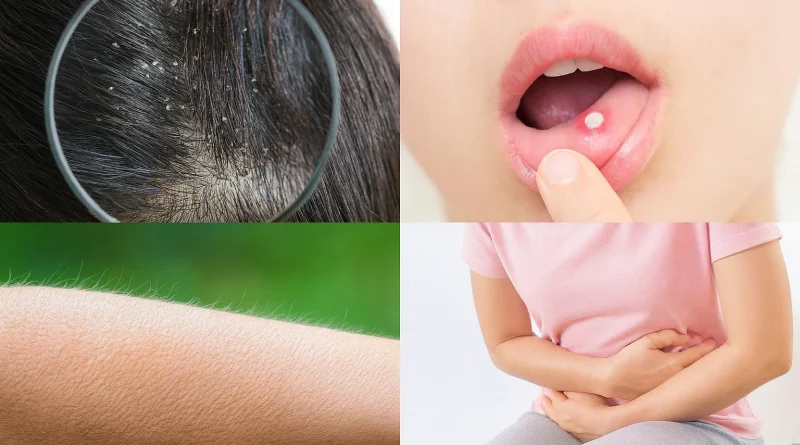 Korpásodás, szájsebesedés, lúdbőr, székrekedés? Ez a vitamin hiányzik a szervezetedből!